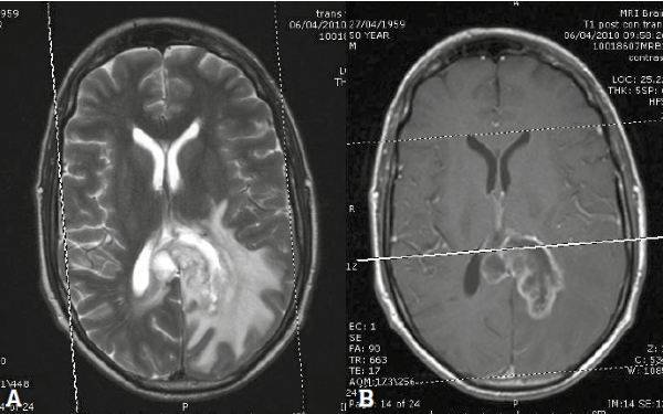 Злокачественная внутримозговая опухоль: А - Т2-взвешенное изображение, показывающее образование в левых теменной и затылочной долях; В - постконтрастное Т1-взвешенное изображение, усиление визуализации