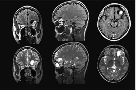 МРТ: глиальная опухоль левой лобной доли головного мозга с кистозным компонентом