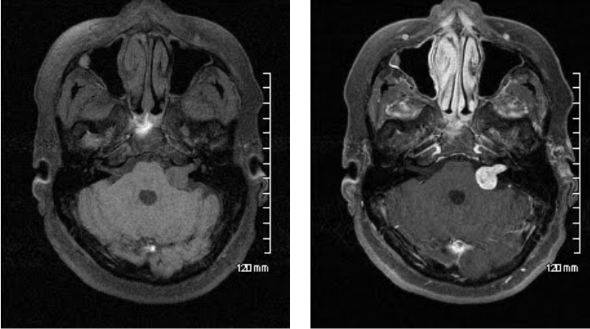 МРТ головного мозга нативная и с усилением: шваннома левого внутреннего слухового нерва становится ярче после введения гадолиния